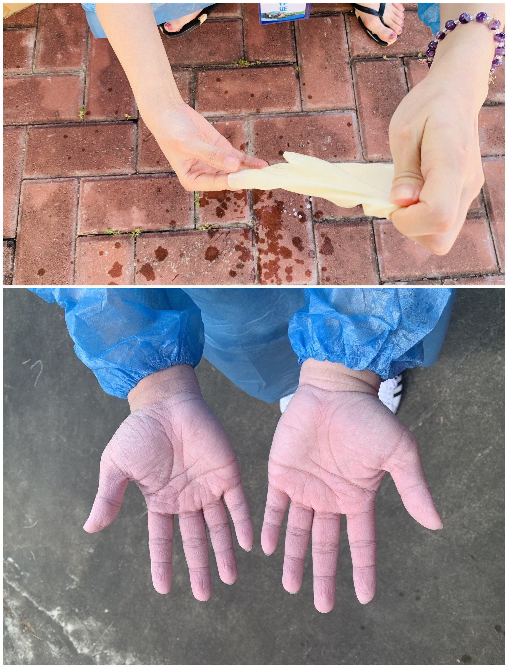 防疫一线工作人员的双手：脱掉手套，在汗水和消毒液浸泡下发皱变白.jpg